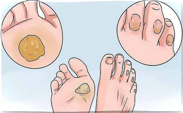 10 remedies to say goodbye to corns and blisters