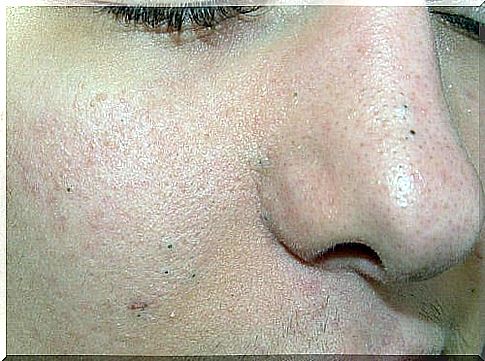 Black spots on the nose and cheeks.