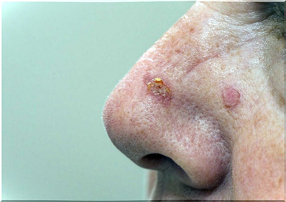 Actinic keratosis: causes, symptoms and treatment