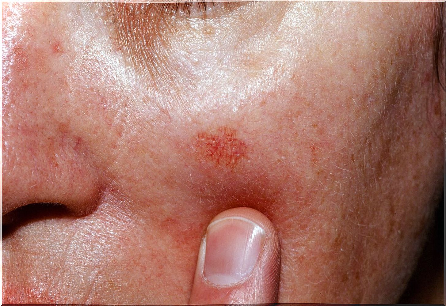 Actinic keratosis