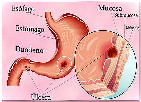 Adjuvant treatment for stomach ulcers