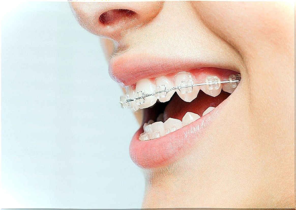 What are ceramic braces?