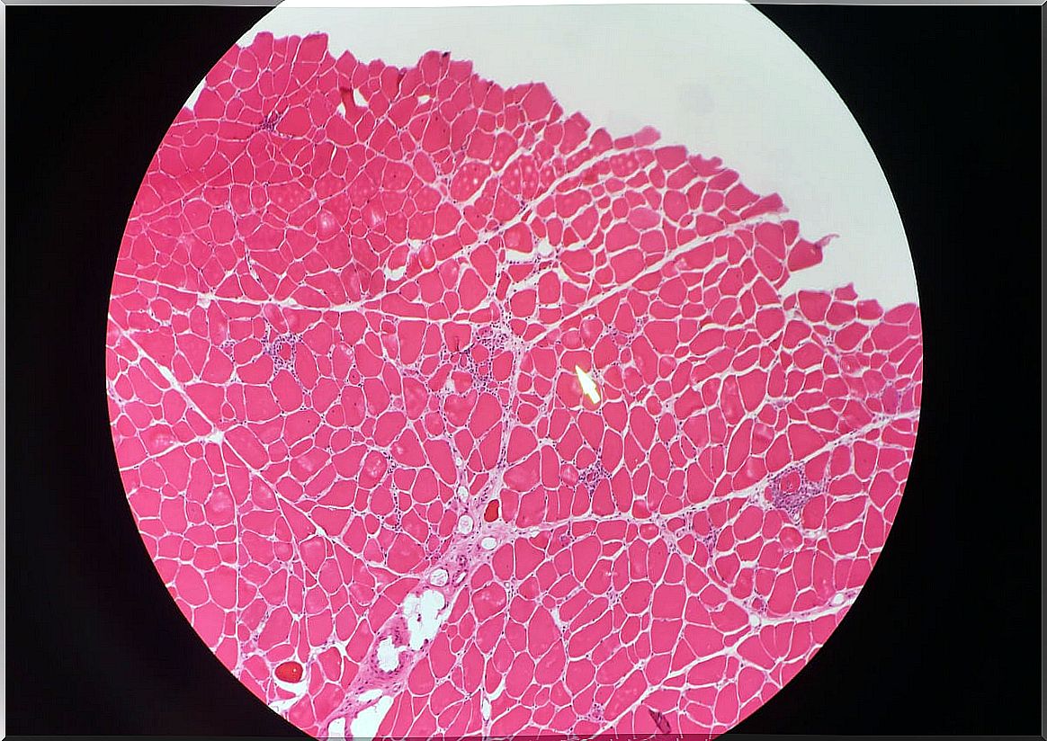 How is dermatomyositis diagnosed?