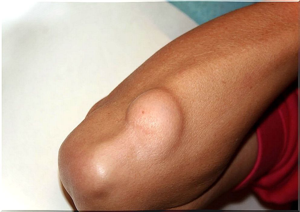 Man with lipoma arm