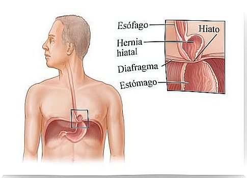 Is a hiatal hernia curable?