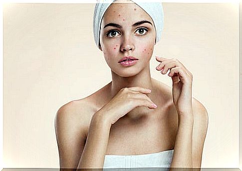 Steps for acne skin