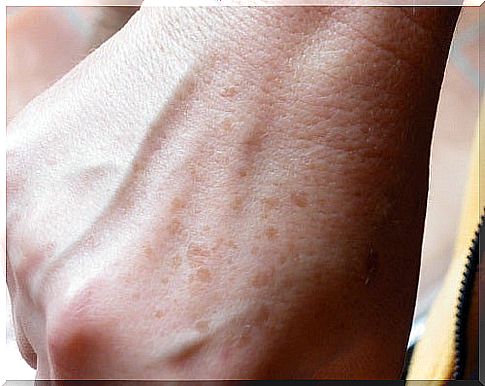 What can we do with spots and freckles on our hands?