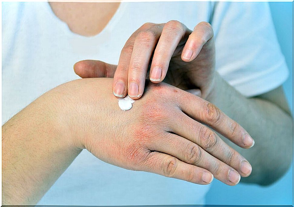 Hydrate yourself to avoid stains and freckles on your hands