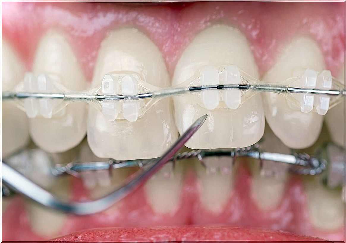 Braces to treat overbite.