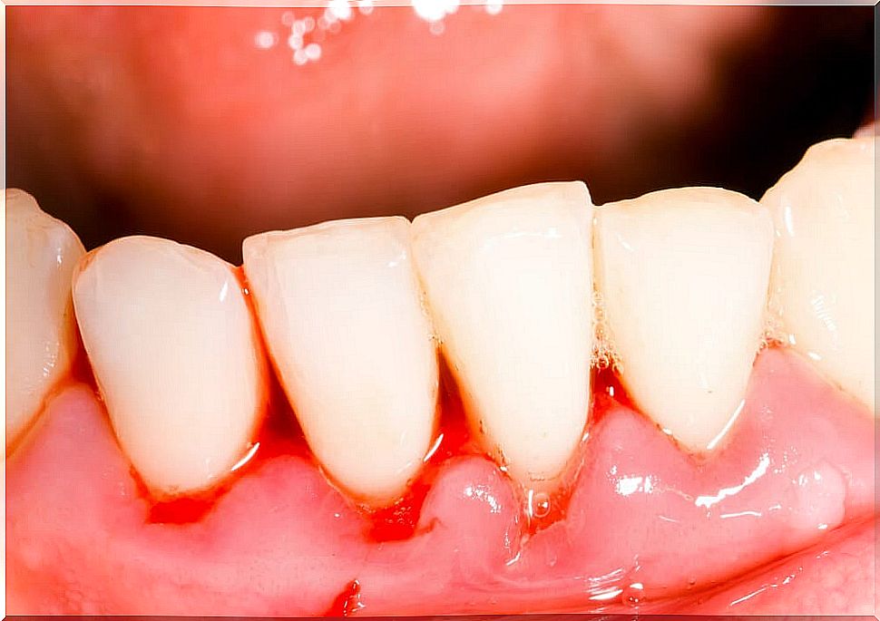 Why gingivitis occurs